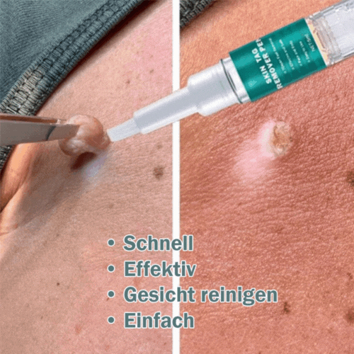 Hautwucherung Entferner Pen – Schnell und Effektiv – Für Gesicht und Körper